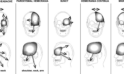 Exploring Vagus Nerve Stimulation for an Alternative Treatment Option for Paroxysmal Hemicrania (PH) Relief